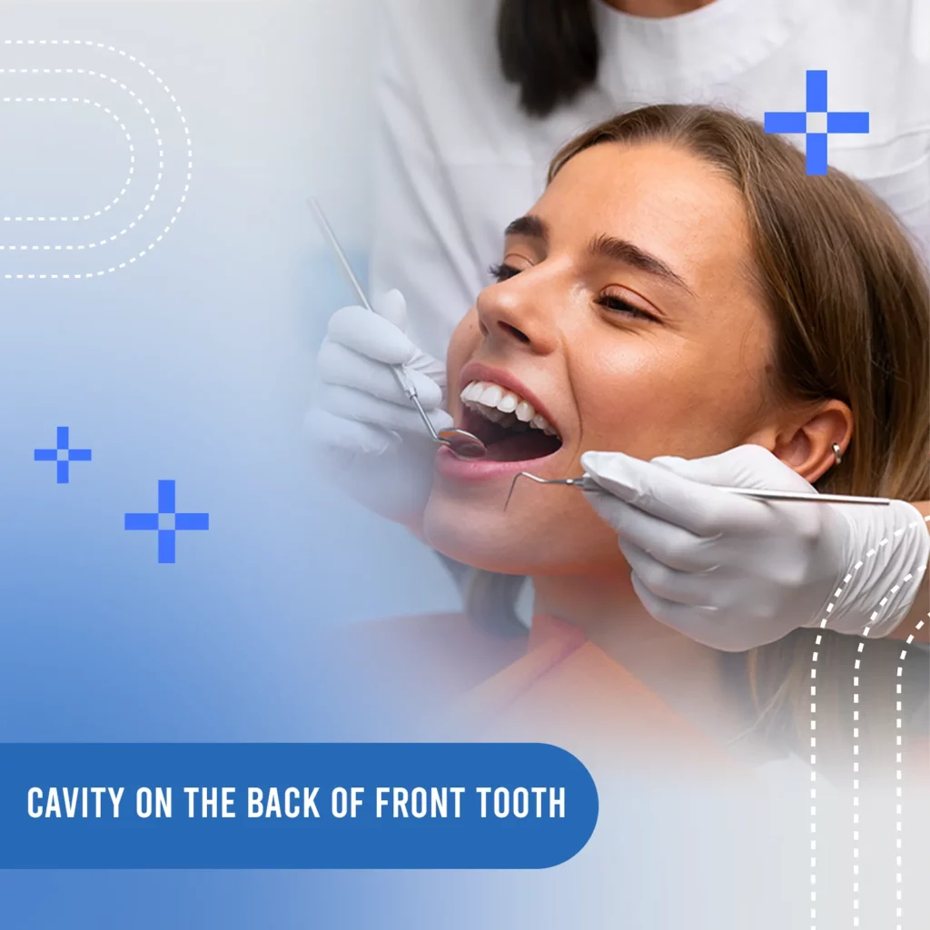 cavity on the back of a front tooth?
