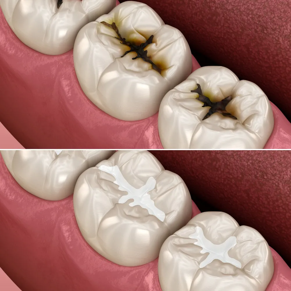 What is a dental filling? 