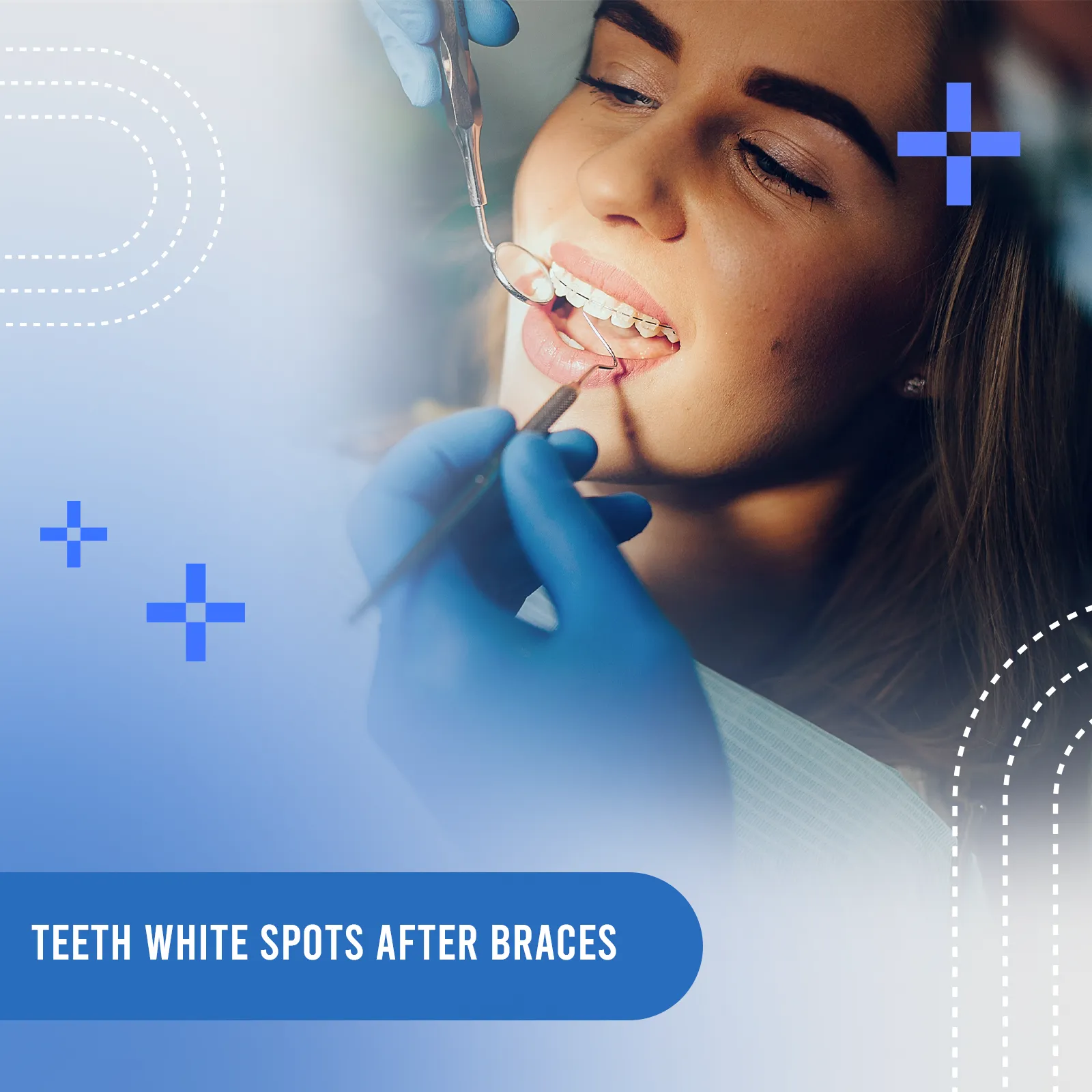 teeth white spots after braces